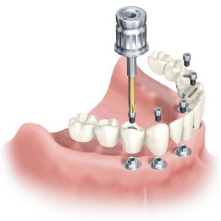 Implantes Oseointegrados