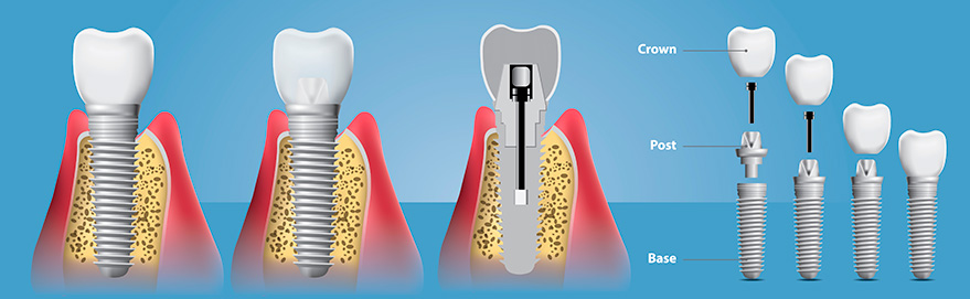 Implantes Oseointegrados